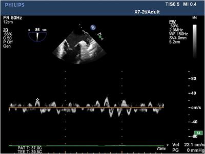 Relationship between left atrial appendage peak flow velocity and nonvalvular atrial fibrillation recurrence after cryoablation